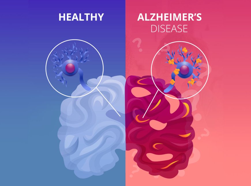 ALZHEIMER'S DISEASE